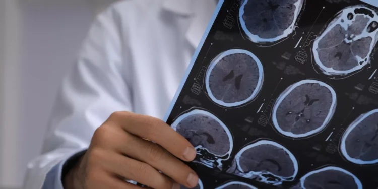 Novo tratamento contra esclerose múltipla pode estar a caminho