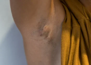 O que é Hidradenite Supurativa, a doença crónica que ouviu em ‘Casados’?