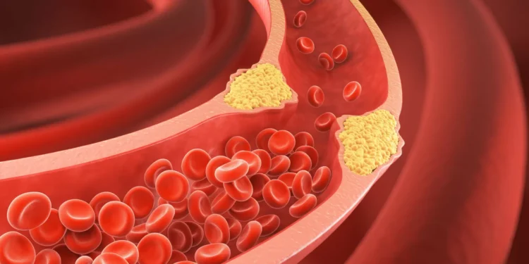 Seis alimentos que ajudam (e muito) a desobstruir as suas artérias