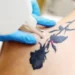 Nada é para sempre: cresce o movimento de remoção de tatuagens