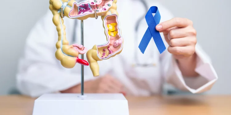 Prevenção do cancro do cólon: Médicos recomendam início aos 40 anos