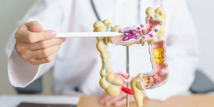 Cancro colorretal: Biópsia líquida mostra resultados promissores