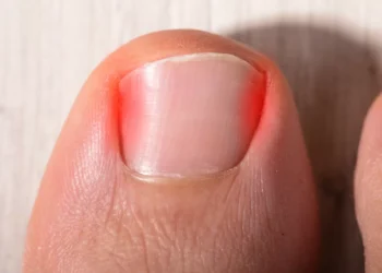 O que causa e como pode prevenir as unhas encravadas