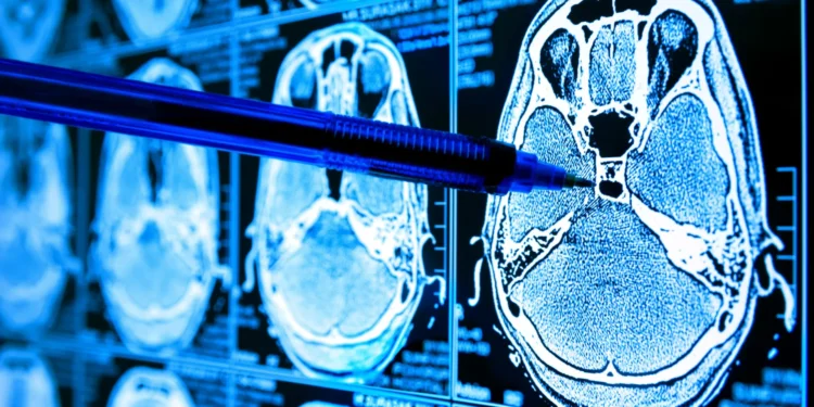 Descoberta sobre glicose no cérebro pode ajudar a combater Alzheimer