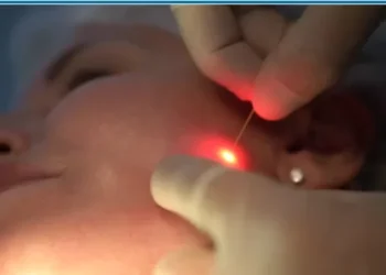 Quem disse que é só a Coreia? Laser da Itália promete acabar com gordura localizada e flacidez, sem cortes