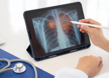 Estudo revela como a sua dieta pode aumentar risco de cancro do pulmão