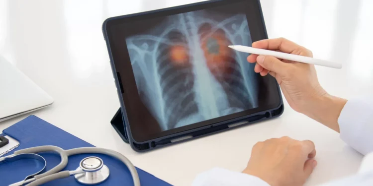 Estudo revela como a sua dieta pode aumentar risco de cancro do pulmão